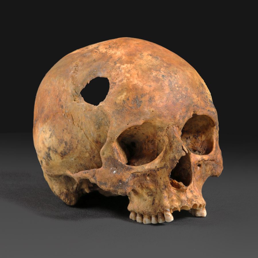 Czaszka ze śladem trepanacji, ok. XVII w., pierwotnie krypta kościoła pw. św. Mikołaja w Sławkowie, Katedra Anatomii UJ CM, Kraków, fot. Bożena i Lech Okońscy